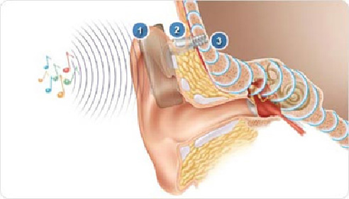 Cochlear image1